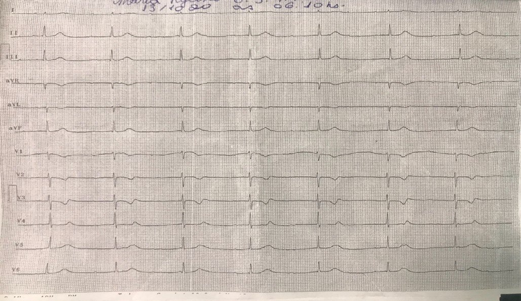 Mujer de 31 años tratada con haloperidol, quetiapina y prometazina por esquizofrenia que presenta caída con pérdida de consciencia en quién se constata QTL y se sospecha desarrollo de TdP