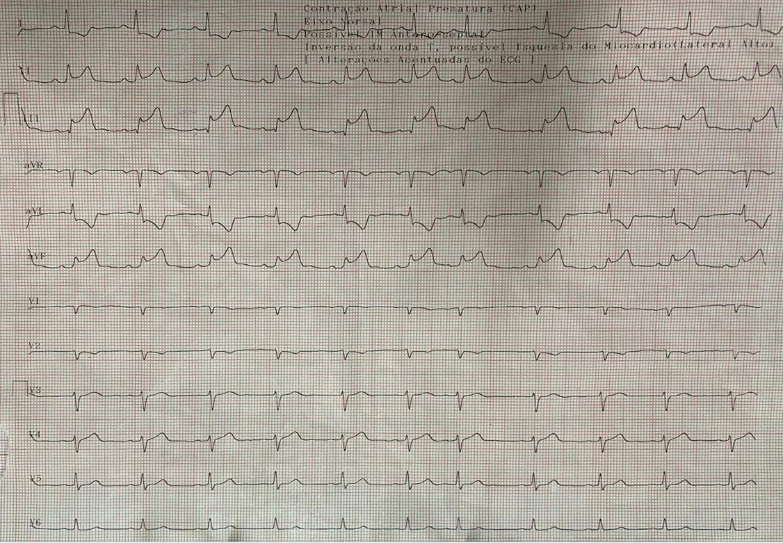 Mujer de 54 años que presenta ángor nocturno a quién se practica trombolisis y se planifica realizar angioplastia de rescate que en realidad presenta angina vasospástica, siendo tratada con nitratos y calcioantagonistas a pesar de lo cuál reitera episodio de ángor (ECG con intercambio de electrodos) que cede con nitratos