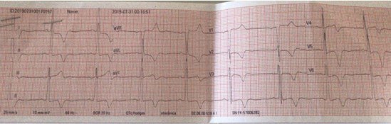 Hombre de 56 años que presenta la rara asociación de miocardiopatía hipertrófica apical + presencia de membrana subaórtica