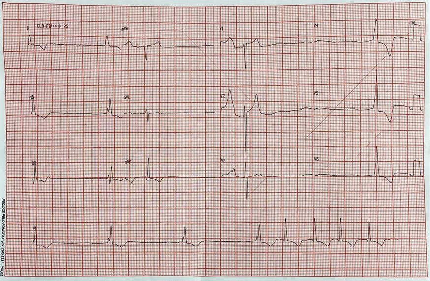Paciente hospitalizado en espera de cirugía de revascularización miocárdica que presenta ritmo de la unión vinculado a hiperpotasemia