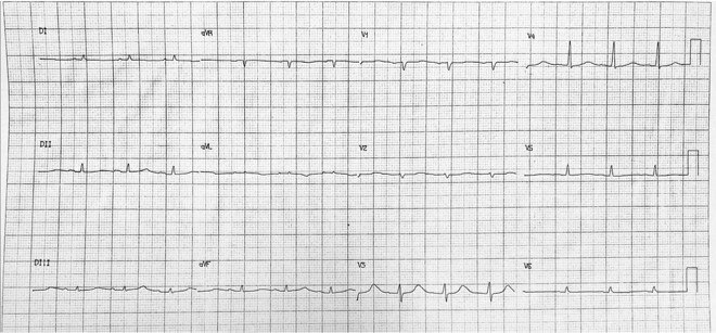 Mujer de 74 años que ingresó con SCACEST inferior, tratado con stent en arteria Cx evolucionando con calambres musculares, con antecedentes de tiroidectomía total por CA de tiroides y paratiroidectomía iatrogénica con severa hipocalcemia