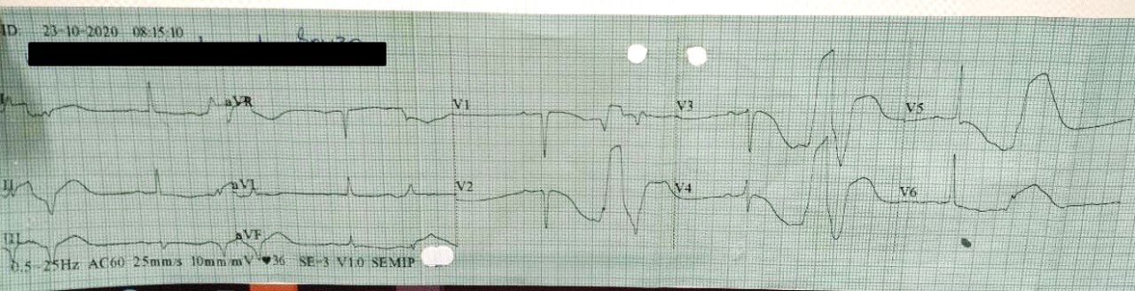 Mujer de 83 años en uso de un diurético que presenta ángor prolongado y episodio sincopal que presenta hipopotasemia y en quién se constatan lesiones en Cd y Cx