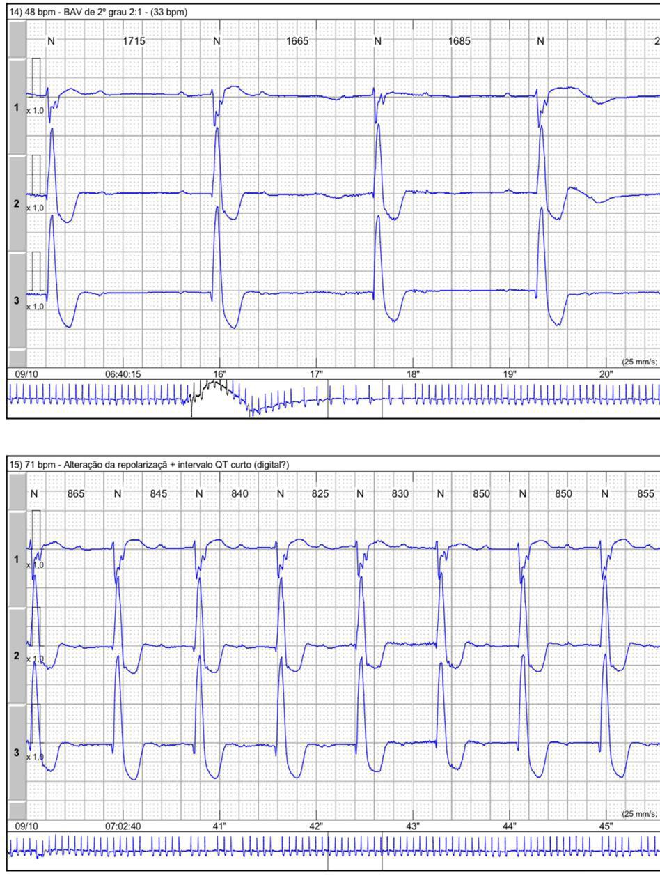 Paciente de 90 años digitalizado, que presenta episodio sincopal por presencia de BAV de distintos grados atribuibles a intoxicación digitálica