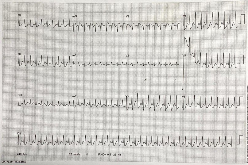 Varón de 23 años con palpitaciones y presencia de taquicardia con QRS estrecho que no respondió al masaje del seno carotídeo ni a la adenosina y sí al metoprolol EV poniendo de manifiesto la existencia de una vía accesoria y el diagnóstico de TRAVO