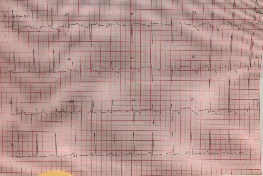 Paciente con factores de riesgo que consulta por episodio de ángor con troponina + que presenta ECG son signos de HVI y que en cuya CCG se observa arteria DA ocluída con llenado por colaterales de la CD