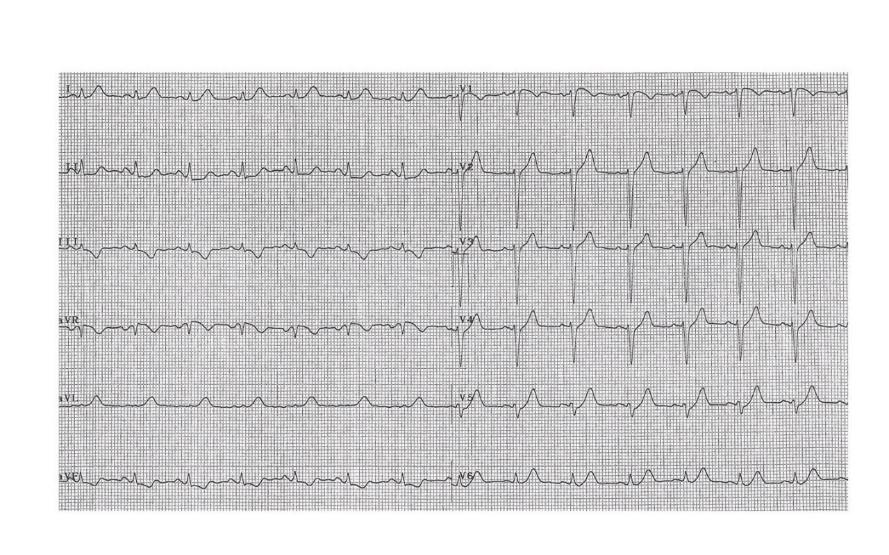 Paciente DBT e HTA que presenta episodio de ángor correspondiente a oclusión de la DA determinando infarto anterior con cambios recíprocos en cara inferior