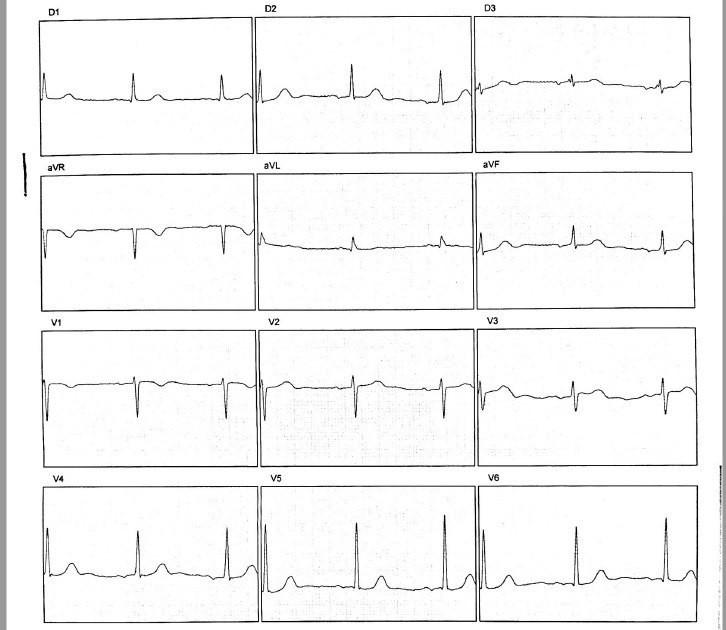 Mujer de 61 años, HTA y DBT con palpitaciones en cuyo Holter presenta extrasístoles auriculares aisladas, con presencia de BIA-A en el ECG, discutiéndose si corresponde indicar anticoagulación en forma preventiva