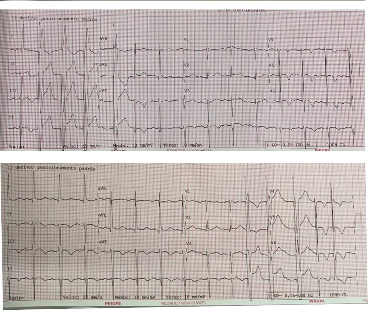 Paciente portador de MPC y antecedente de reflujo gastroesofágico, que presenta dolor precordial atípico prolongado y pico hipertensivo, hallazgo de HVI en eco y troponina -, en quién se constatan ondas T negativas (memoria cardíaca) y que presenta gastritis y esofagitis diagnosticadas por VEDA