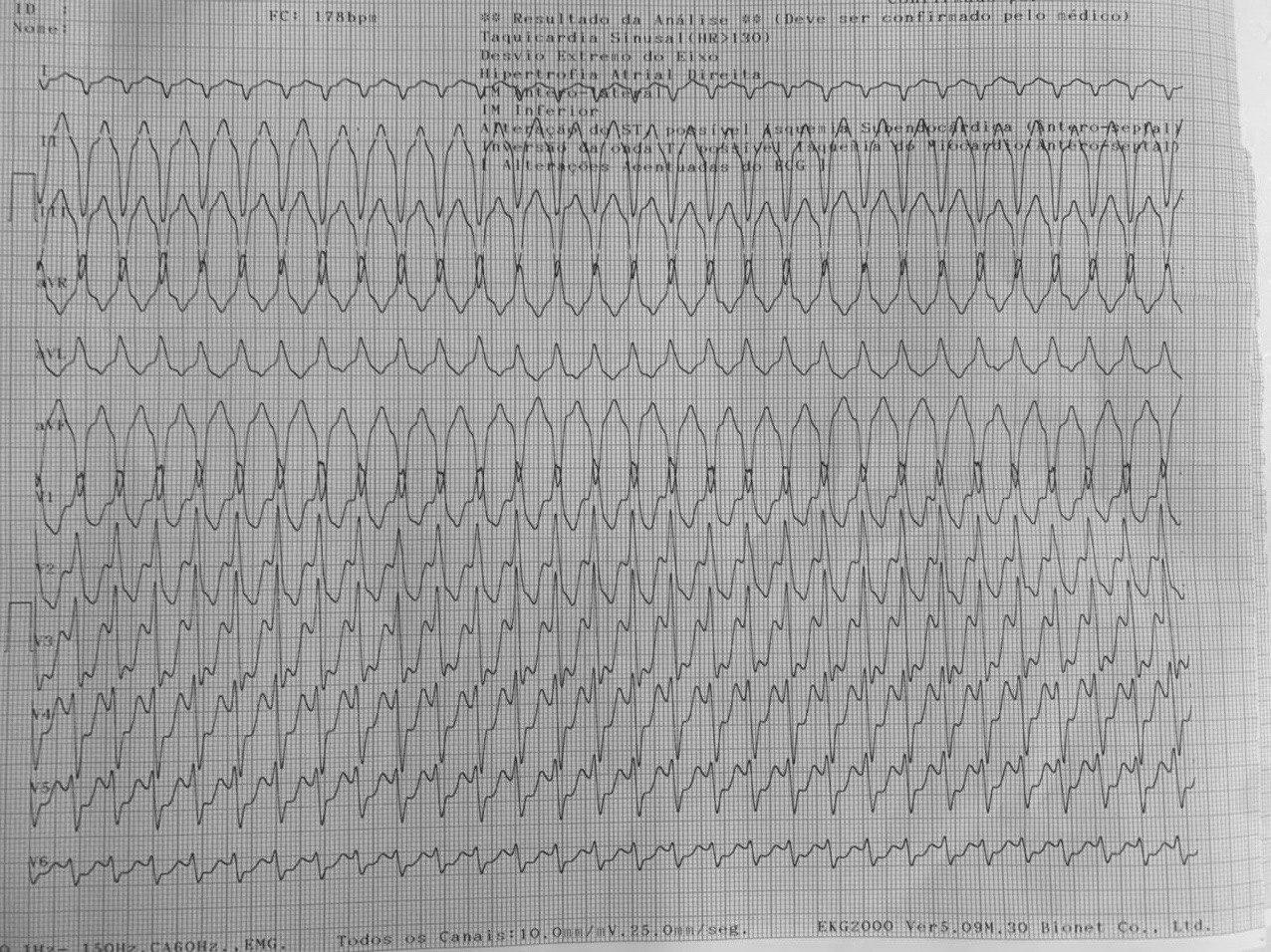 Masculino de 84 años con antecedentes de implantes de stents que presenta episodio sincopal por desarrollo de TVMS  que al revertir muestra secuela de necrosis inferior y BCRD