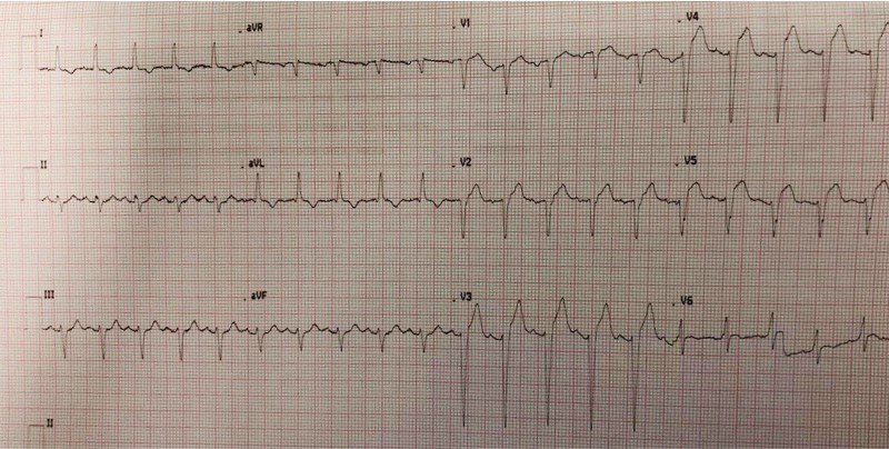 Paciente diabético de 49 años que presenta ángor progresivo y signos de congestión pulmonar que presenta suboclusión de TCI