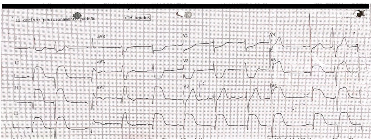 Paciente masculino de 70 años que presenta episodio de ángor y presíncope por compromiso de CD que fue angioplastiada con mal resultado final, desarrollando posteriormente taquicardia ventricular e hipotensión que requirió CVE