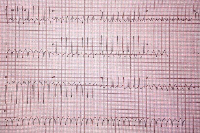 Varón de 30 años, consumidor de cocaína y alcohol con palpitaciones debidas a TV fascicular posterior con ondas T negativas por memoria cardíaca