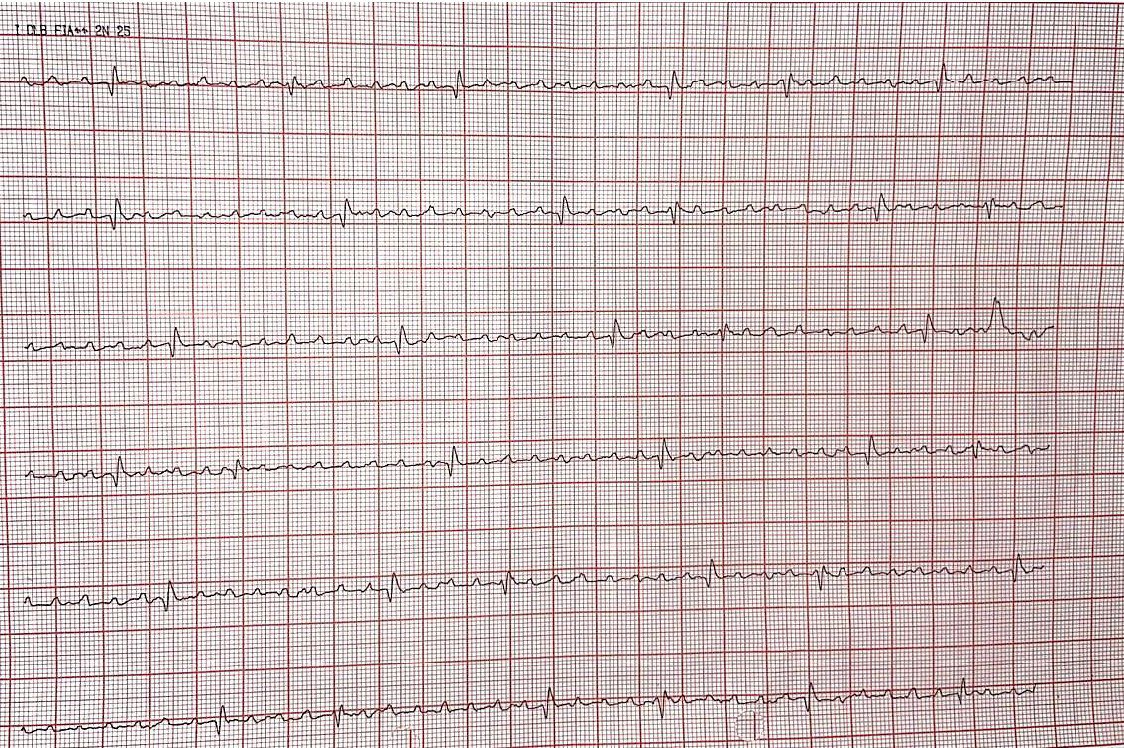 Paciente de 51 años portador de miocardiopatía dilatada chagásica con hemiplejía desde hacía 10 meses y disnea progresiva  con episodio de síncope, aleteo auricular que revierte espontáneamente vinculado a signos de BIA y en cuyo Holter se detectan episodios de TPSV, TVNS y pausas prolongadas