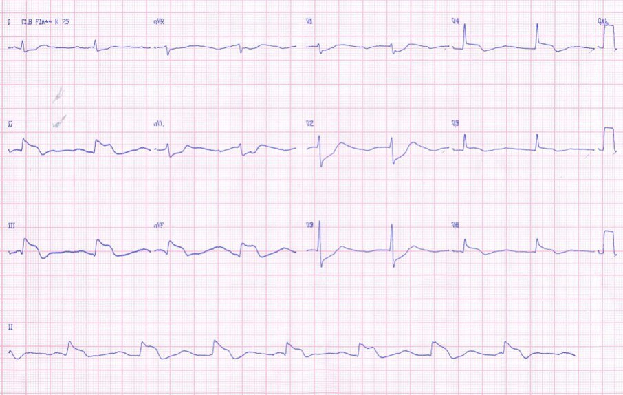 Paciente que presenta ángor prolongado por desarrollo de IAM inferior con discutible presencia de signo de Spodick por infarto auricular