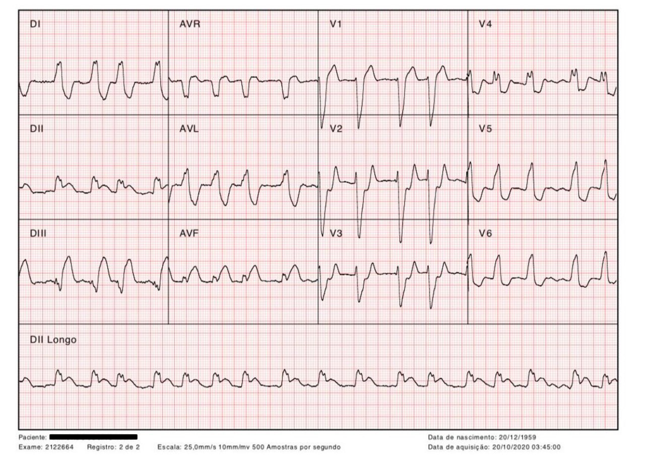 Paciente de 60 años, HTA, con antecedentes familiares de enfermedad coronaria que ingresa con ángor, por desarrollo de IAM inferior, con BCRI y FA, con signo de Sgarbossa +