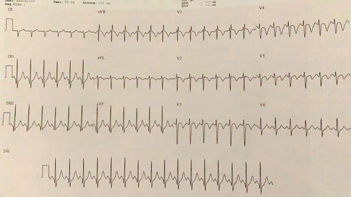 Paciente masculino de 22 años COVID + con intensa disnea por desarrollo de TEP que requiere inmediata anticoagulación