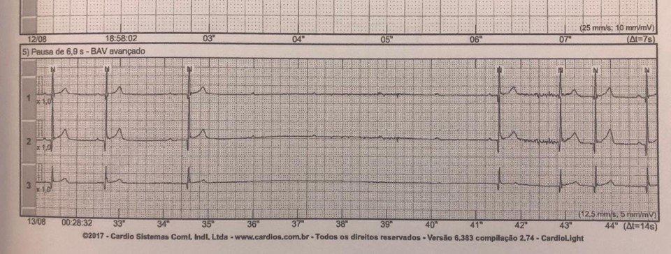 Paciente asintomático de 26 años que durante el sueño presenta un bloqueo de alto grado de origen vagal a quién se indica tratamiento con ventilación con presión positiva continua (CPAP) durante las horas de sueño, con presiones de 7,5 cm H20