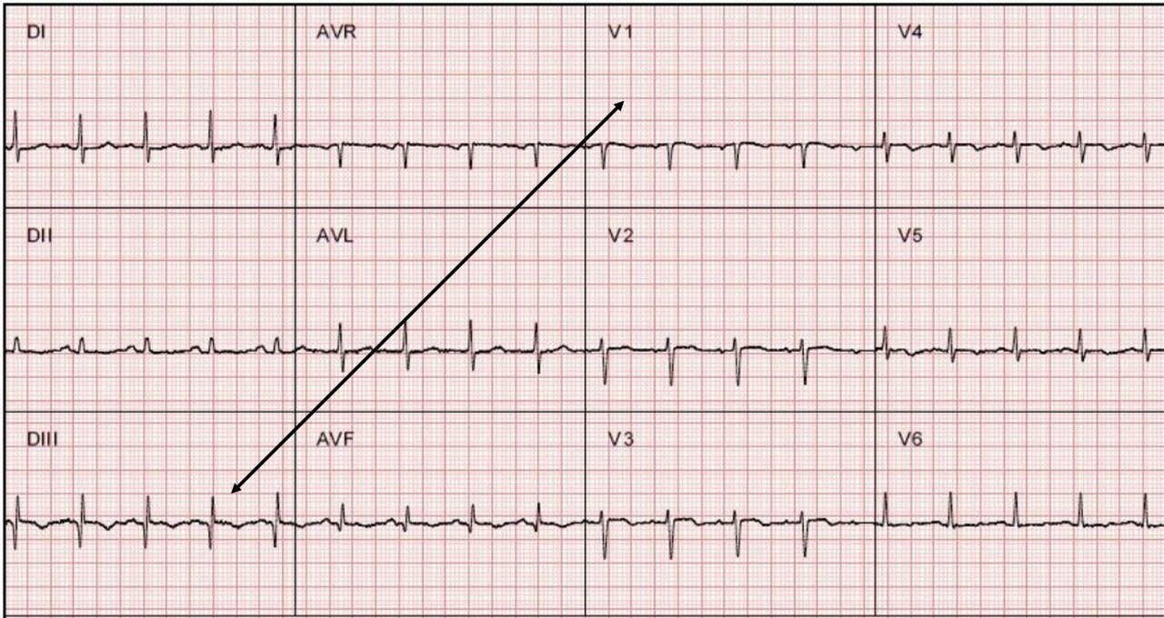 Mujer de 42 años que presenta síncope y disnea precedidos por malestar general, cuyo ECG muestra patrón S1Q3T3 por TEP