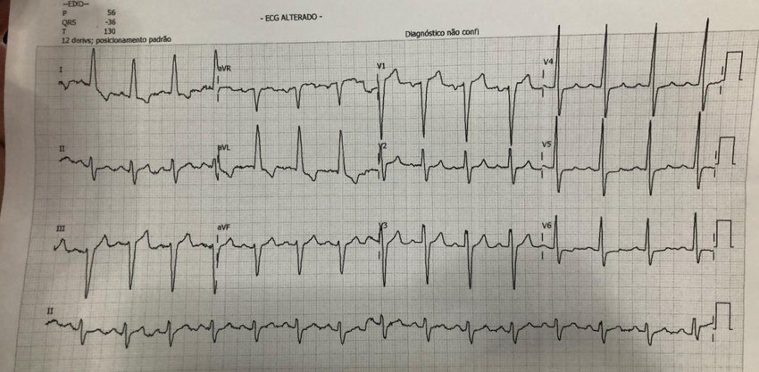 Paciente de 54 años, HTA, portador de «corazón grande» y antecedentes familiares de enfermedad coronaria, que presenta ángor y disnea siendo internado en una sala de pacientes COVID+ cuyo ECG muestra FA, infarto ínferolateral y BCRI por embolización de ramas 1º y 2º marginal de Cx, con sospecha de contagio del COVID