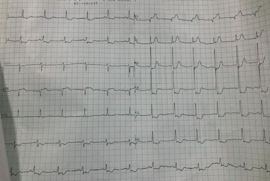 Varón de 76 años con factores de riesgo que presenta episodio de ángor prolongado con saturación de 83% por compromiso de DA proximal con imagen del monitor que muestra elevación persistente del segmento ST, sin reperfusión miocárdica