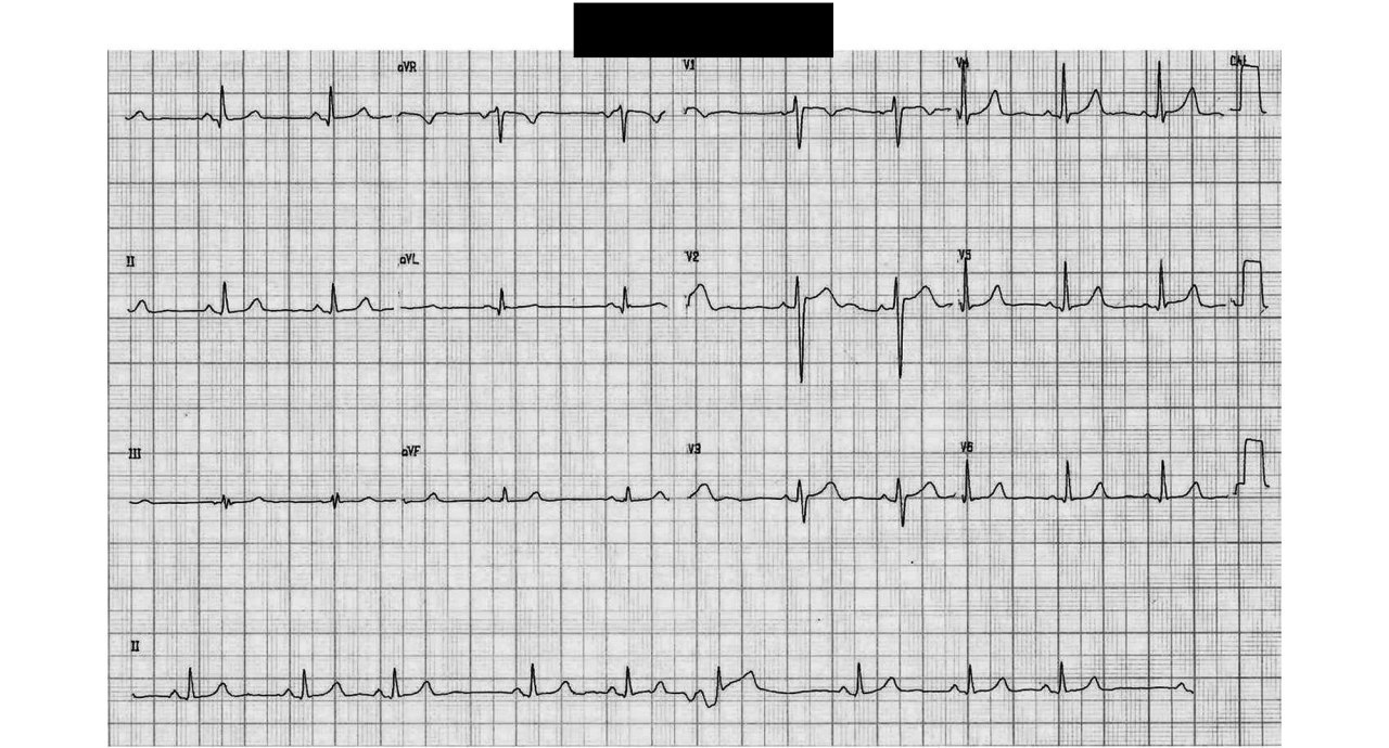 Niño de 11 años con historia de dos episodios de pérdida súbita del conocimiento durante esfuerzo, con hermano de 8 años que presentó MS, a quién se realiza PEG durante la cual presenta TV catecolaminérgica