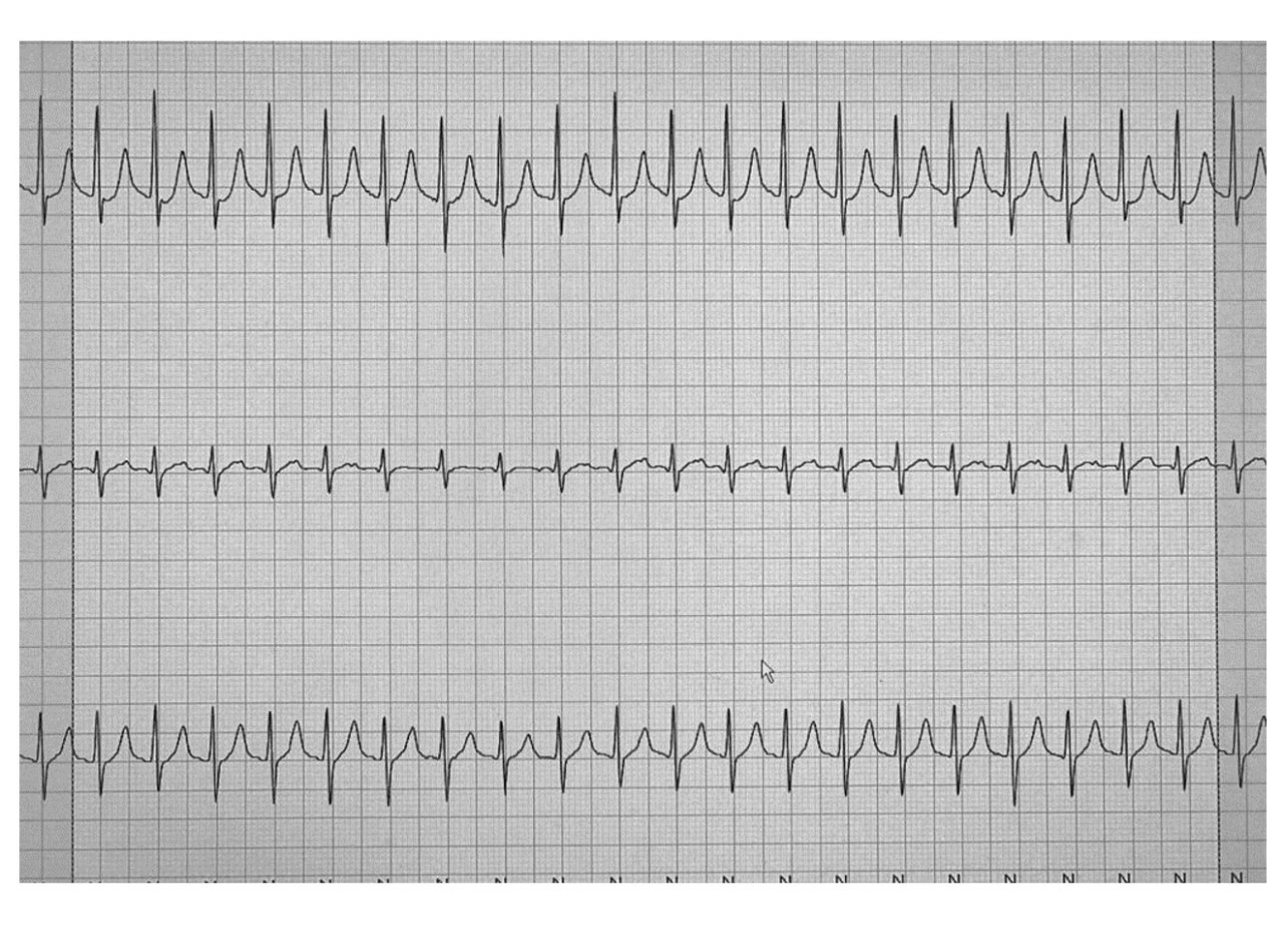 Paciente de 71 años, HTA en cuyo Holter se detecta AA 2:1 que cumple la regla de Bix