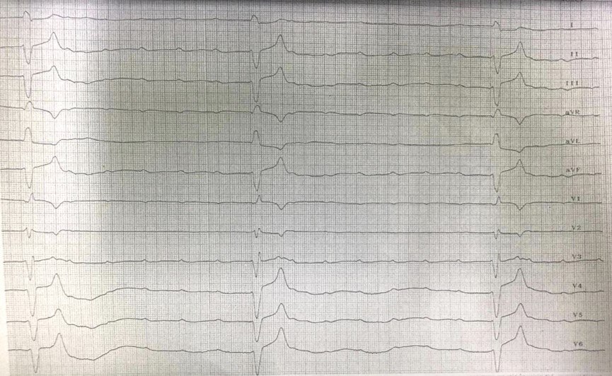 Paciente de 72 años de edad, HTA y DBT en tratamiento con Enalapril 10 mg c/12 h y Furosemida 40 mg con severa hiperpotasemia que presenta BAVC y es tratado con gluconato de Ca