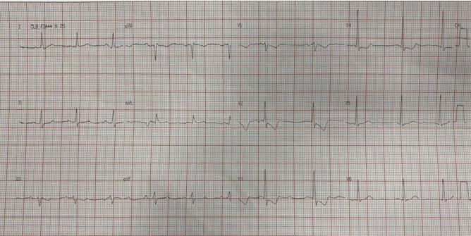 Mujer de 67 años con factores de riesgo con antecedentes de CRM con implante de injerto de safena a la marginal de Cx y CD (Dp) + stent en DA que presenta episodio de ángor en quién se constata obstrucción del 30% de DA intra-stent, oclusión proximal 100% del bypass a MgCx y CD con irregularidades difusas