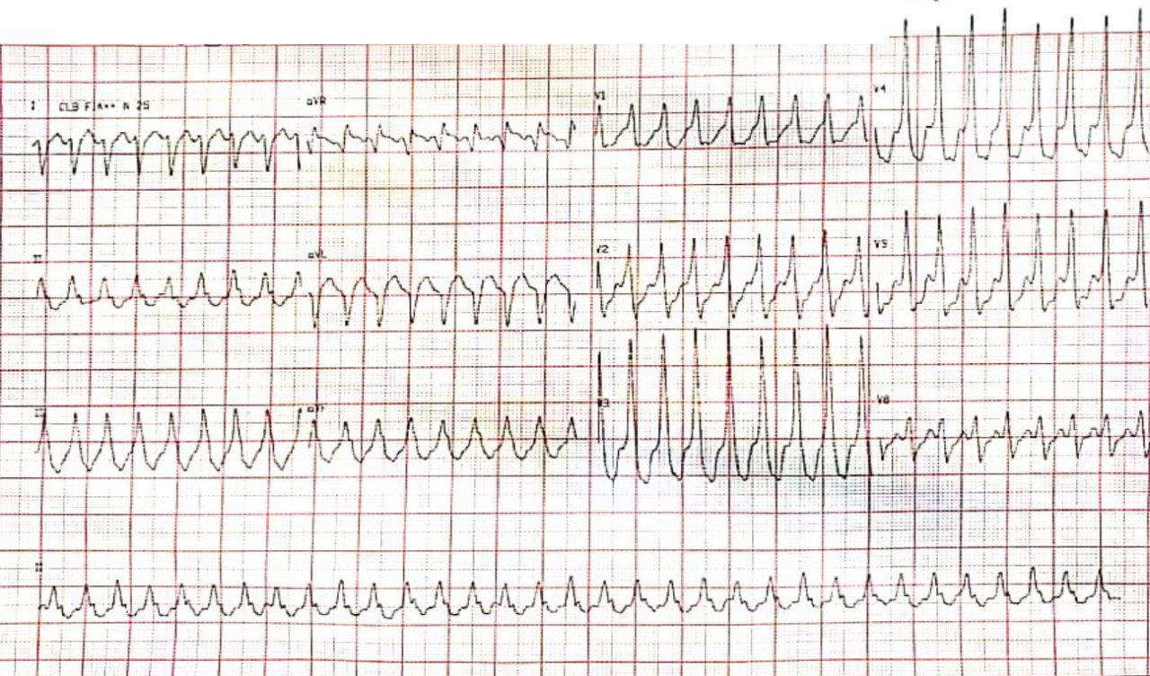 Paciente masculino de 53 años en tratamiento antirretroviral con palpitaciones y dolor en hemitórax izquierdo acompañado de manifestaciones vagales que presenta TV sostenida que revierte con amiodarona EV  por miocardiopatía chagásica concomitante