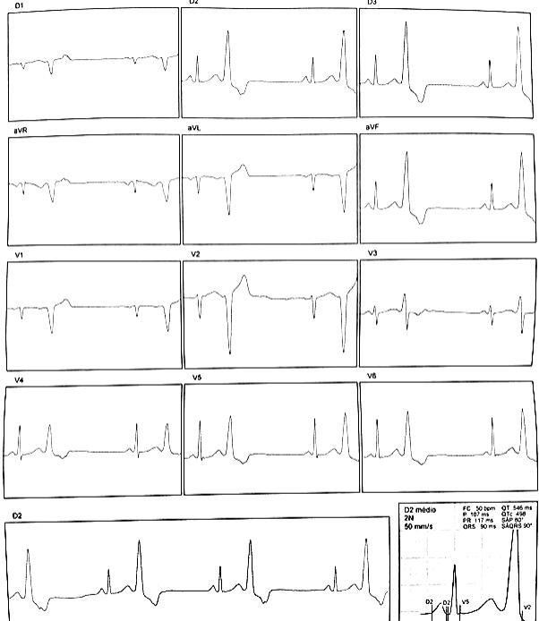 Paciente de 43 años con palpitaciones de larga duración por ECG que muestra bigeminismo ventricular con acoplamiento fijo y largo, conducción VA consistente y probable origen en el TSVD siendo tratado con sotalol con posterior desarrollo de síncope convulsivo con detección de QTcL presumiéndose TdP