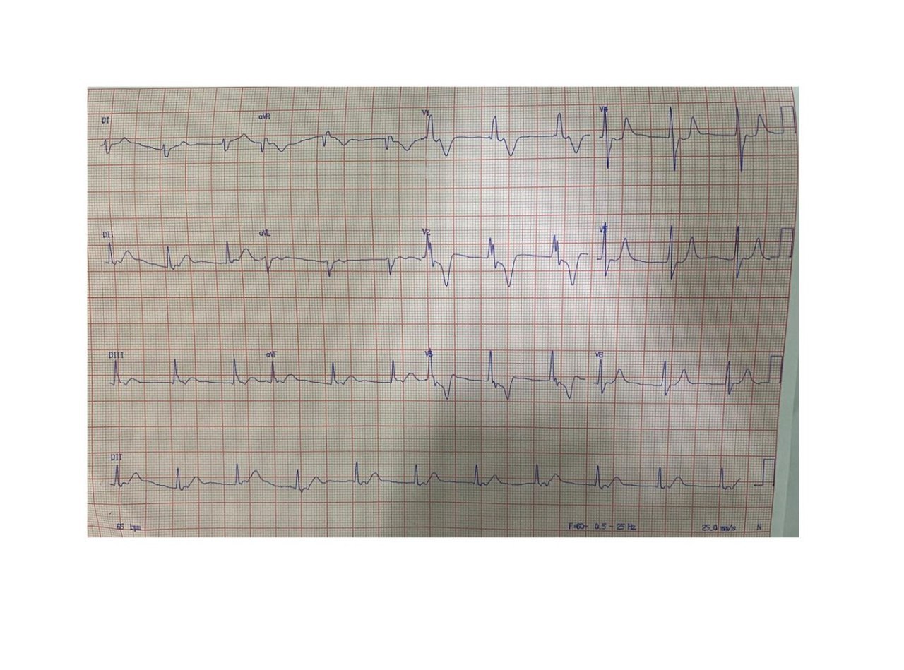 Mujer de 77 años con antecedentes de valvuloplastia y miocardiopatía dilatada que presenta dolor precordial irradiado a MMSS izquierdo, con troponina + que presenta RIVA con conducción VA, CCG normal, por probable embolización coronaria con lisis espontánea de trombos
