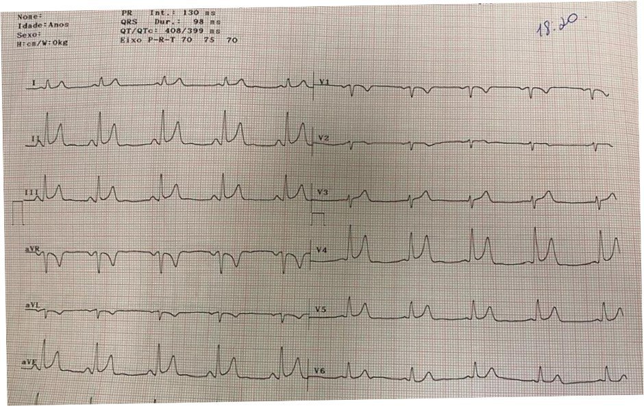 Hombre de 35 años con dolor precordial atípico; troponina negativa y Eco normal con signos ECGs de repolarización precoz