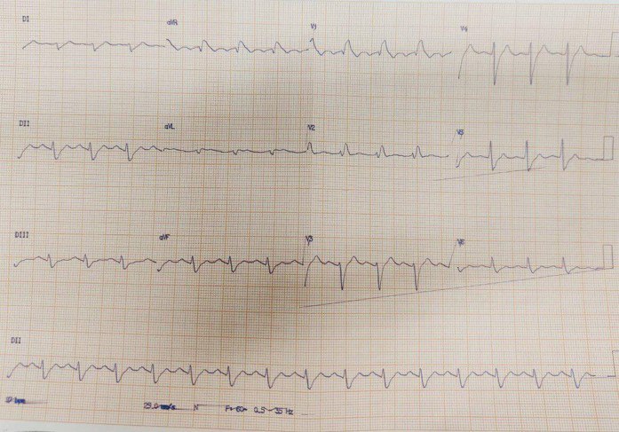 Niño de 13 años que fue encontrado en su domicilio con respiración agonizante siendo reanimado por el Servicio de Emergencias y que presenta un síndrome de Brugada con presencia de signos ECGs de mal pronóstico