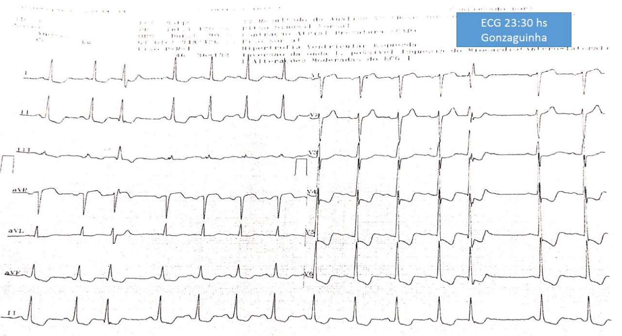 Paciente masculino de 45 años, HTA y alcoholista, con antecedente de ictus hemorrágico 8 años previos, que presenta ángor, palpitaciones y disnea de reposo en quién se detecta aneurisma y disección de aorta ascendente con severa insuficiencia aórtica