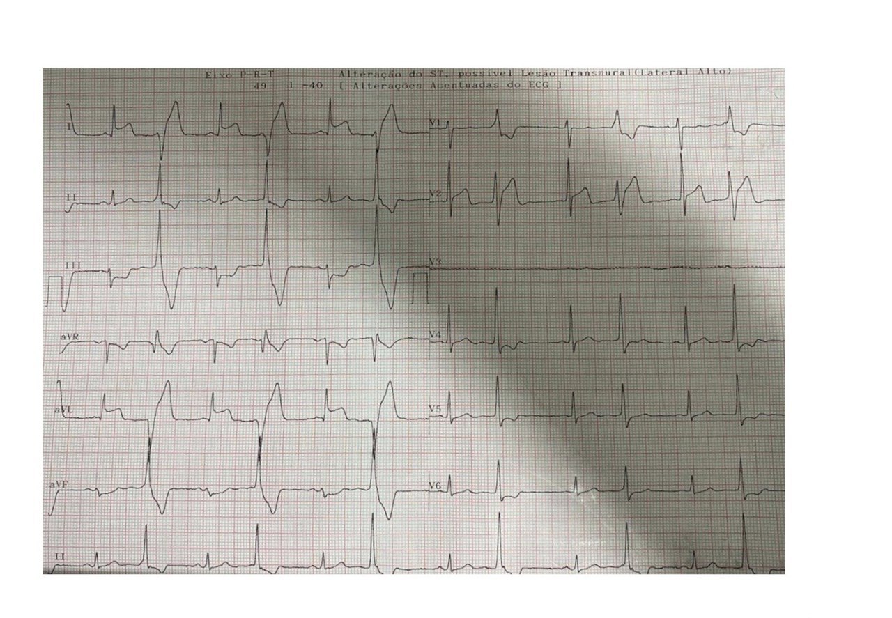 Mujer de 37 años con ángor de reciente comienzo, con episodios nocturnos presentando cambios agudos en el ECG y bigeminia ventricular con CCG normal estableciéndose el diagnóstico de espasmo coronario que responde a calcioantagonistas