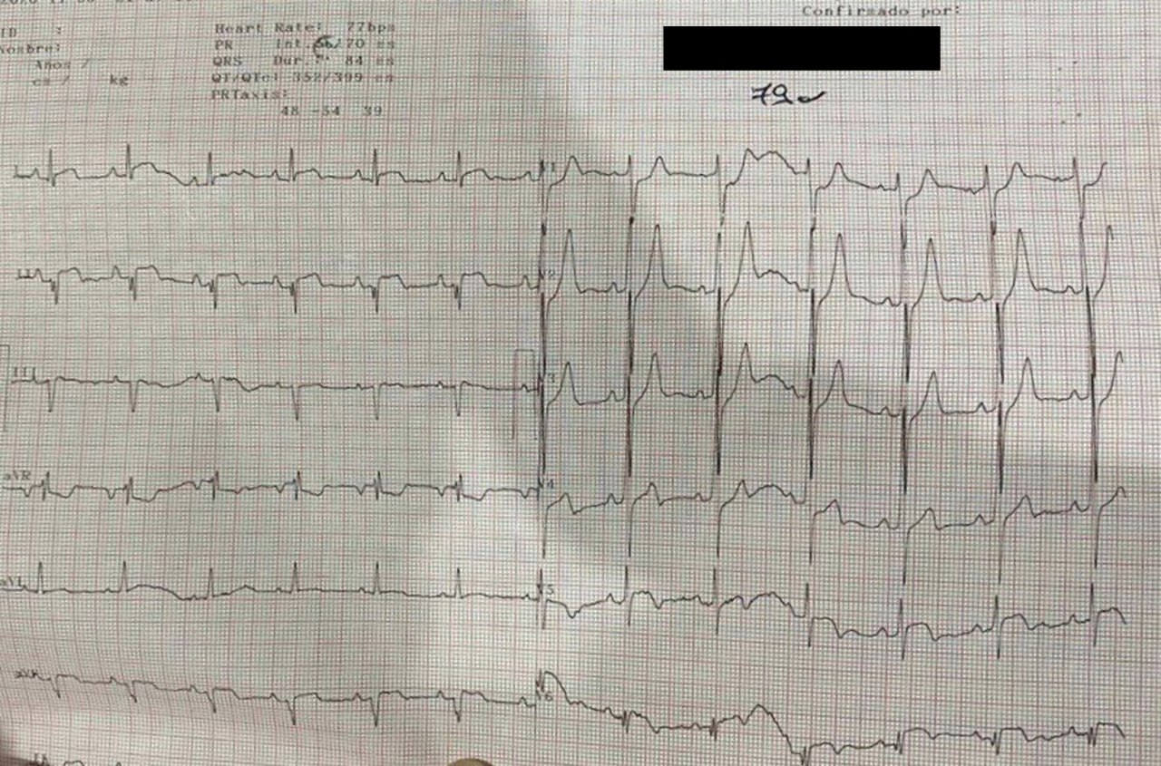 Paciente de 79 años, HTA y DM que presenta dolor precordial típico y troponina positiva con patrón de Winter por compromiso de Cx
