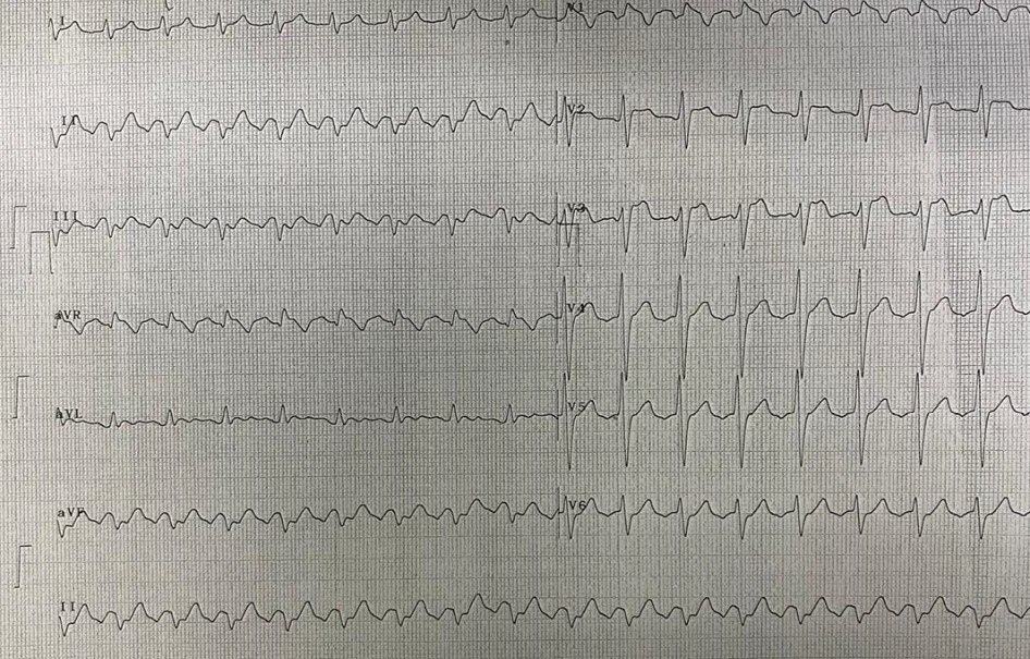 Paciente masculino de 66 años en insuficiencia cardíaca que consulta por empeoramiento de disnea y palpitaciones, con dolor toráccico atípico de leve intensidad que presenta AA y patrón de Brugada tipo I, con signos de iRC e hiperpotasemia que es sometido a diálisis