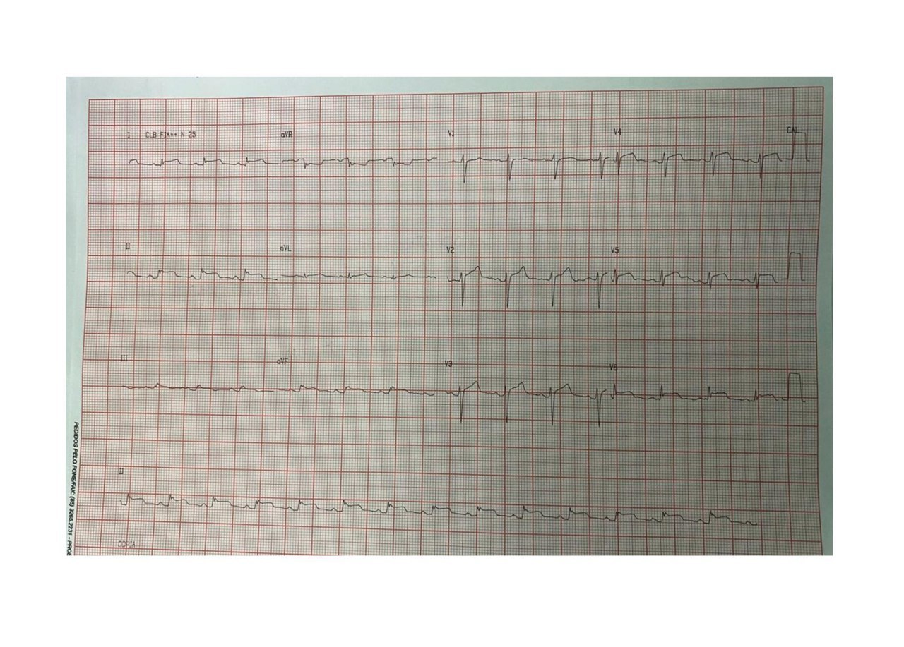 Joven masculino de 19 años con dolor precordial y tos y gran aumento de troponina ultrasensible, con signo de Spodik en ECG caracterizado por el segmento TP descendente e hipocinesia apical de todas las paredes del ventrículo, con disfunción sistólica leve del VI  por presencia de miopericarditis por COVID 19