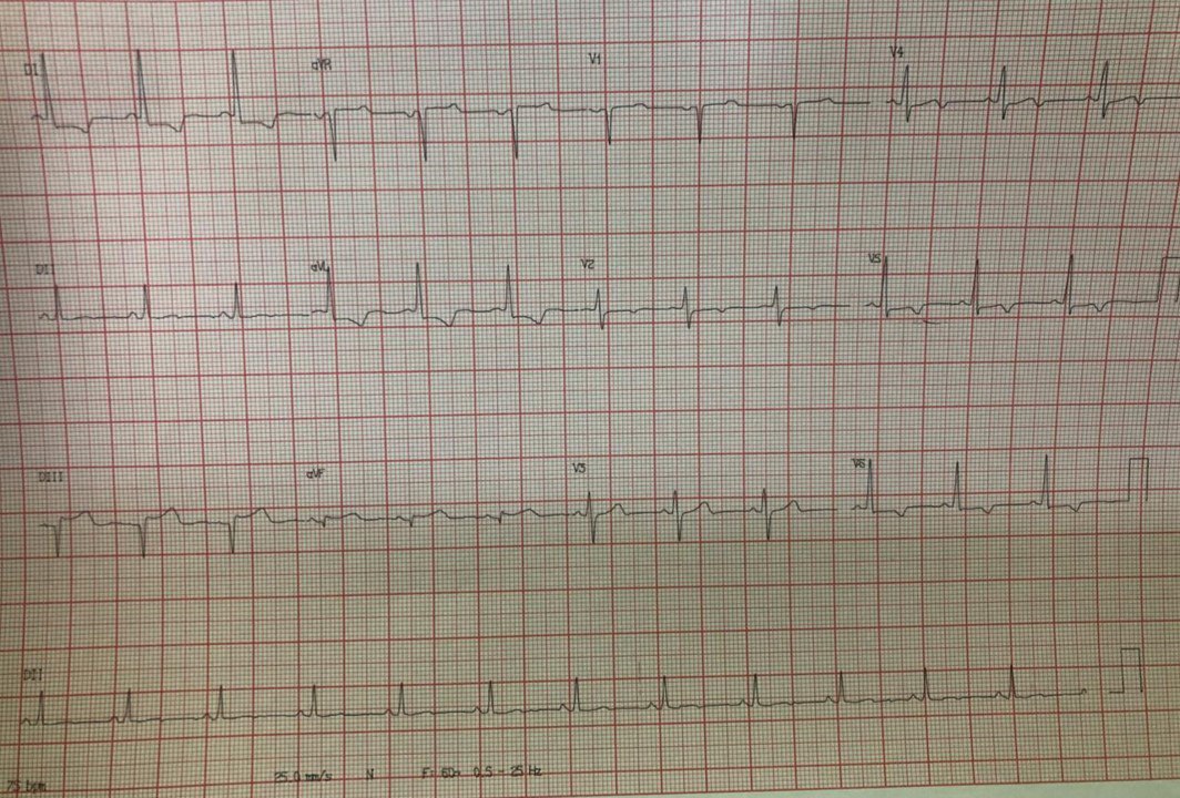 Mujer obesa de 32 años que presenta episodio de ángor por la madrugada siendo derivada directamente a realizar CCG, constatándose  puente muscular sobre la DA e HVI