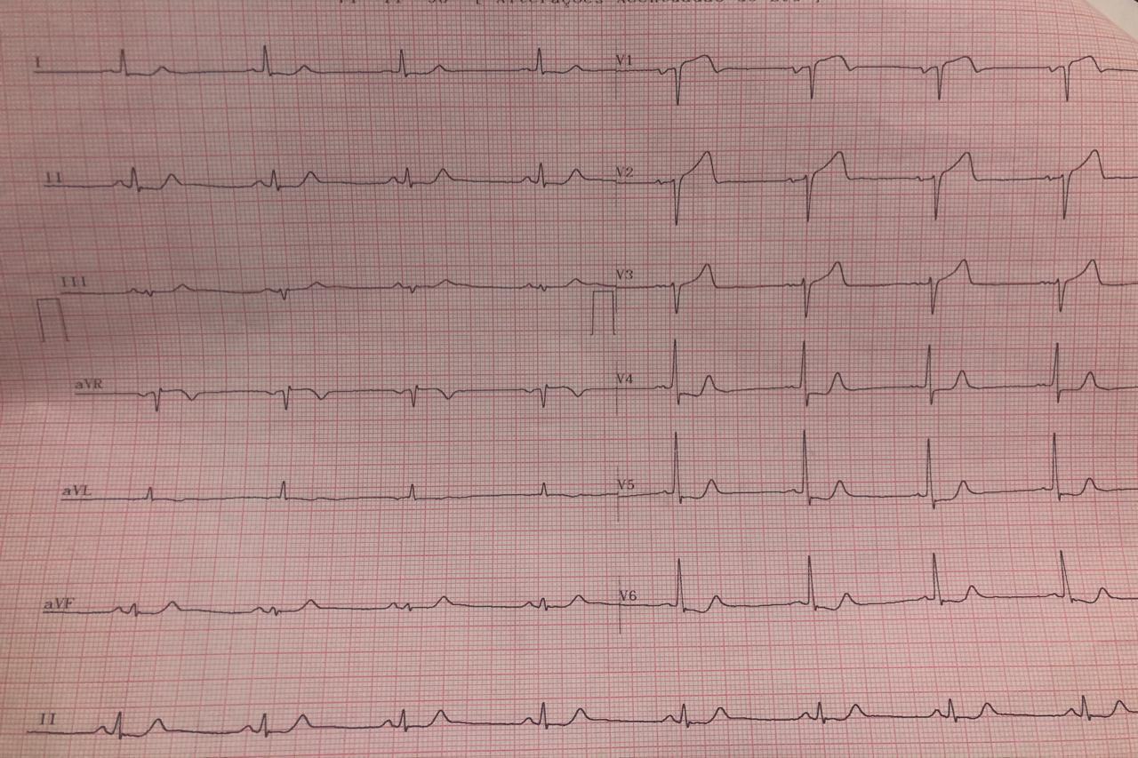 Hombre fumador e hipertenso de 69 años con antecedente de ACV previo que presenta episodio de ángor por oclusión de la DA