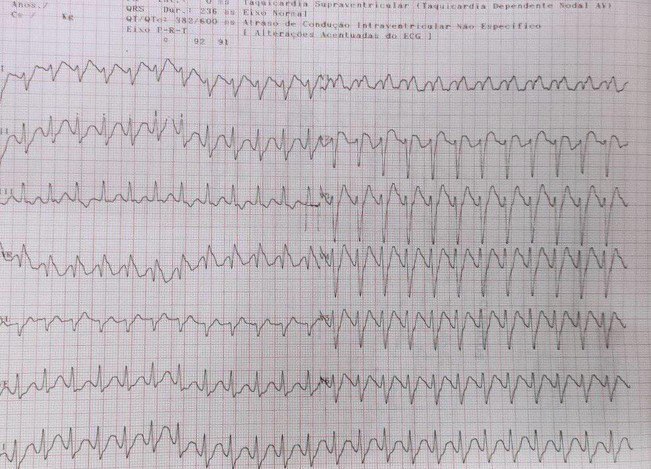 Paciente de 16 años que en intento de suicidio ingiere 20 comprimidos de amitriptilina determinando una TV fascicular asociada a patrón Brugada