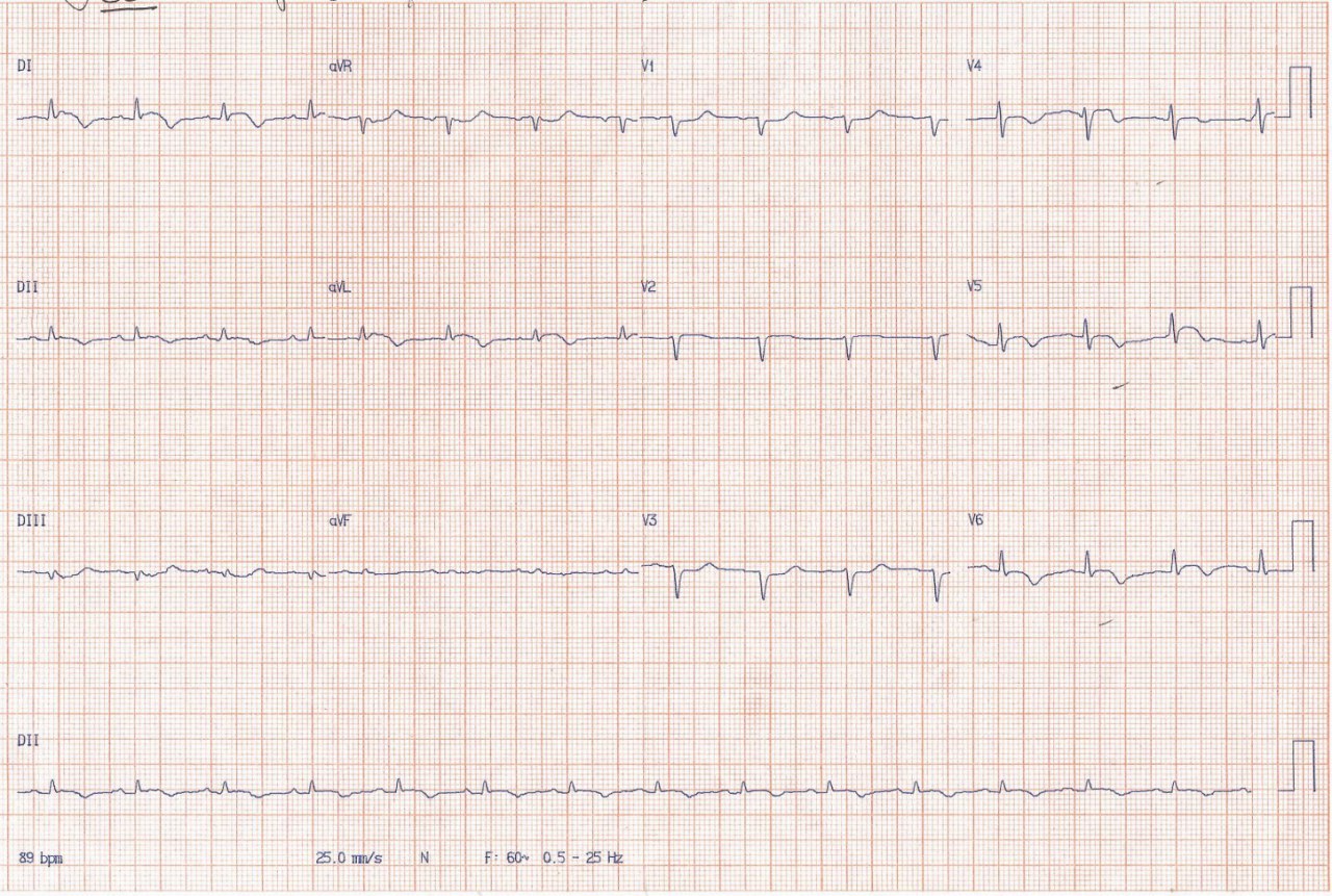 Paciente con enfermedad renal crónica en diálisis con disnea progresiva y síncope por severo derrame pericárdico que es drenado