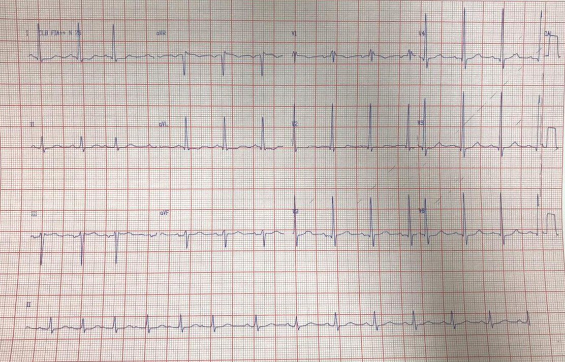 Paciente portador de estenosis aórtica en espera de tratamiento quirúrgico que presenta marcapaso auricular errante y BIA atípico