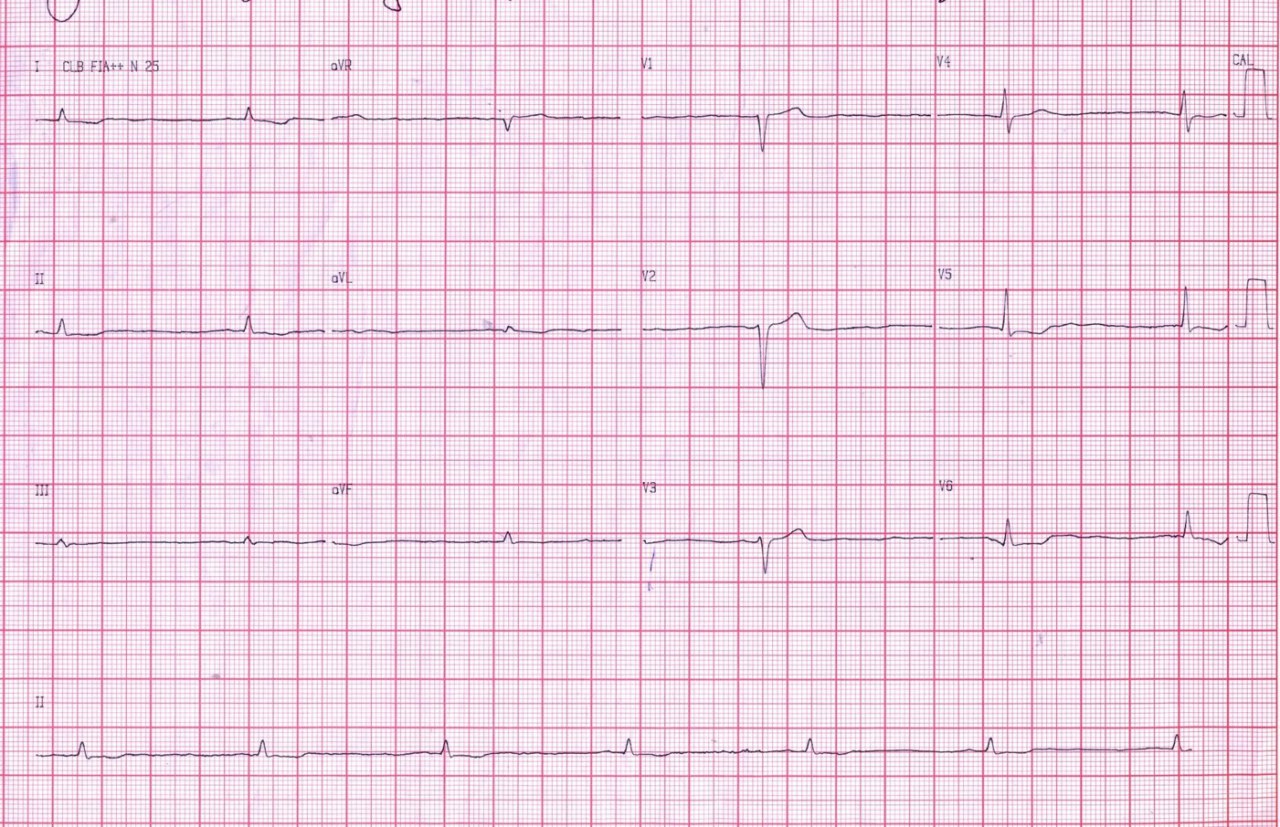 Mujer de  de 52 años con astenia, disnea de esfuerzos y edema de MMII que presenta severo derrame pericárdico por hipotiroidismo