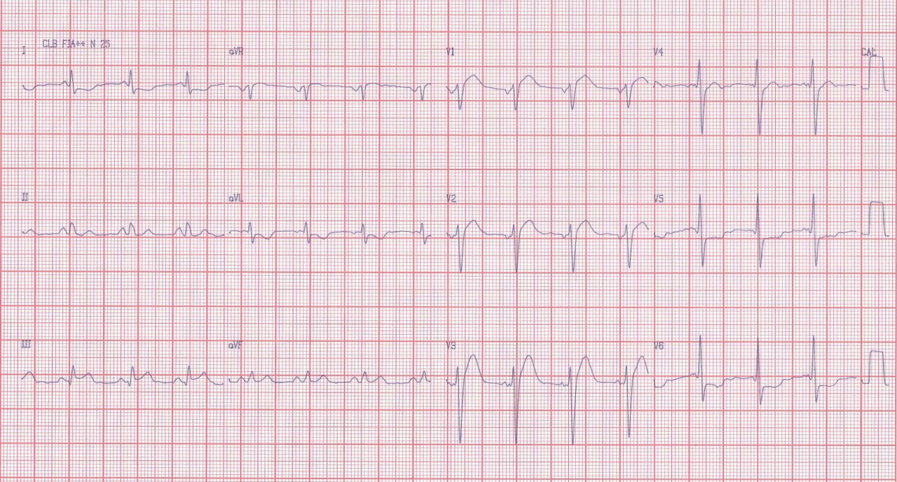 Paciente cursando SCA por oclusión con trombo en origen de CD