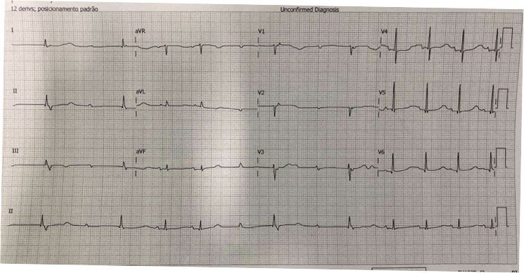 Paciente de 85 años con adinamia que presenta síncope cuyo ECG presenta BAVC y QTc prolongado con probable desarrollo de TdP