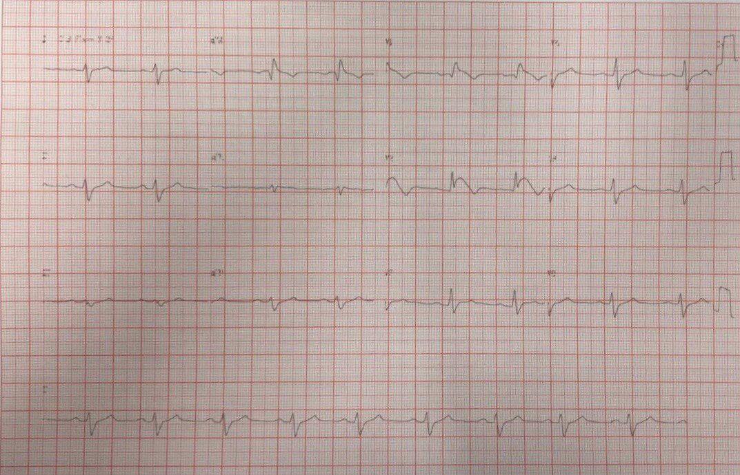 Mujer dd 29 años que desde los 16 se halla en tratamiento anticonvulsivante cor crisis tónicas súbitas sin défict focal, con antecedentes familiares de MS, cuyo Holter mostró períodos de paro sinusal, que presenta ECG con patrón típico de síndrome de Brugada
