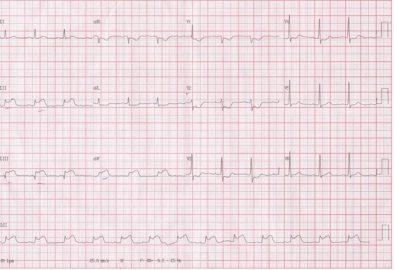 Hombre de 56 años con dolor precordial opresivo prolongado, vómitos, sudoración e irradiación a epigastrio que presenta IAM ínferolateral por compromiso de Cx, que al tercer día desarrolla TV que requiere CVE