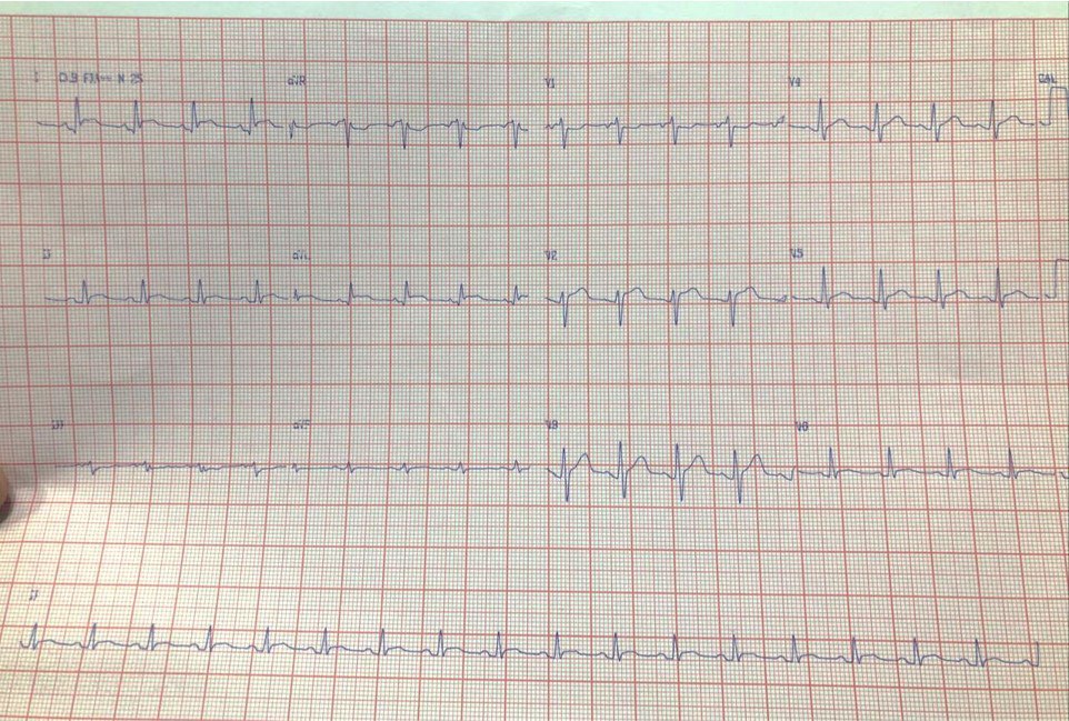 Paciente masculino de 36 años, DBT tipo I, con dolor precordial opresivo irradiado a dorso, prolongado, que cede en posición sentado, con CCG normal por pericarditis