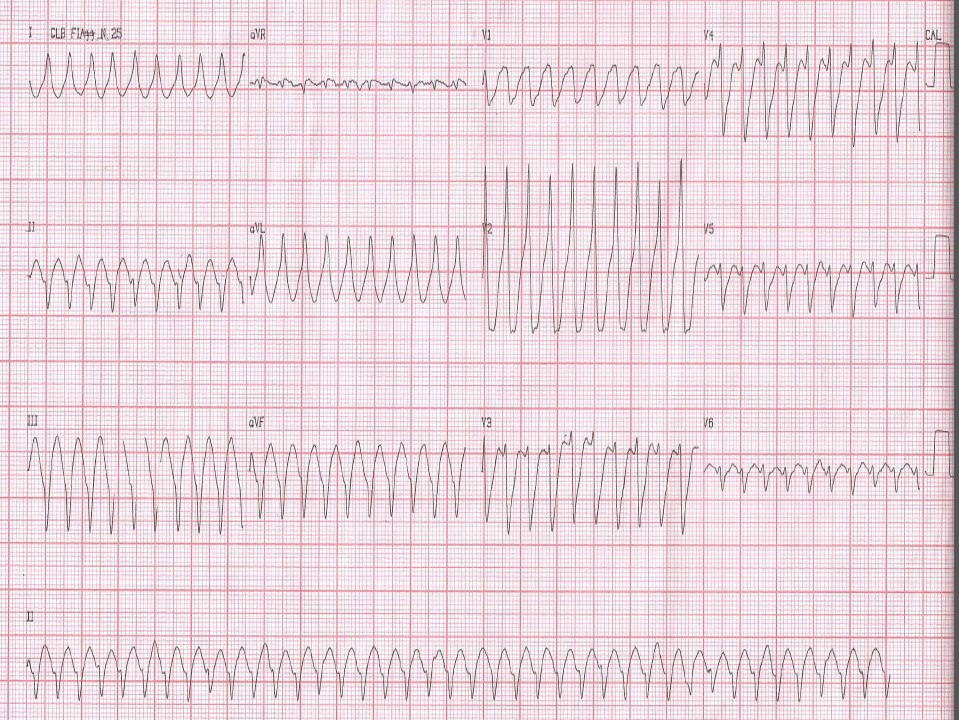 Hombre de 72 años, HTA y tabaquista que presenta ángor ante esfuerzo moderado acompañado de disnea que repite a su ingreso con manifestaciones neurovegetativas y soplo de regurgitación mitral por IAM lateral por oclusión total de la Cx